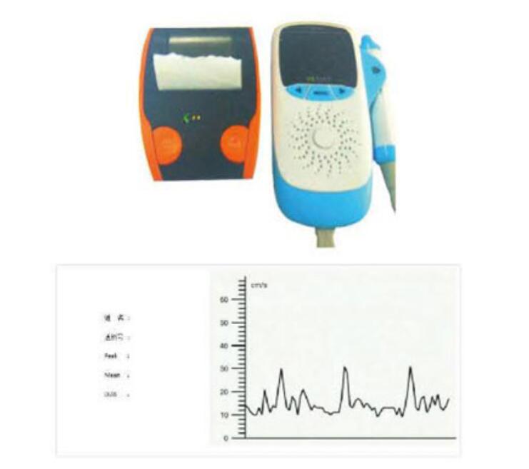 YW-100超声多普勒血流检测仪 多普勒血流探测仪 诊察设备4